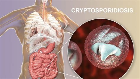  Cryptosporidium: A Tiny Parasite Capable of Triggering Epic Diarrhea Storms!